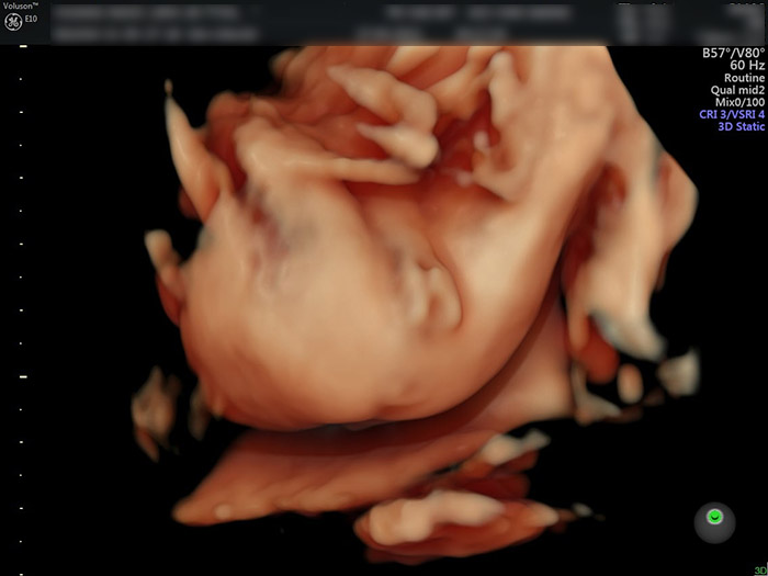 Xem ngay hình ảnh siêu âm 4D bé gái sinh động như thật