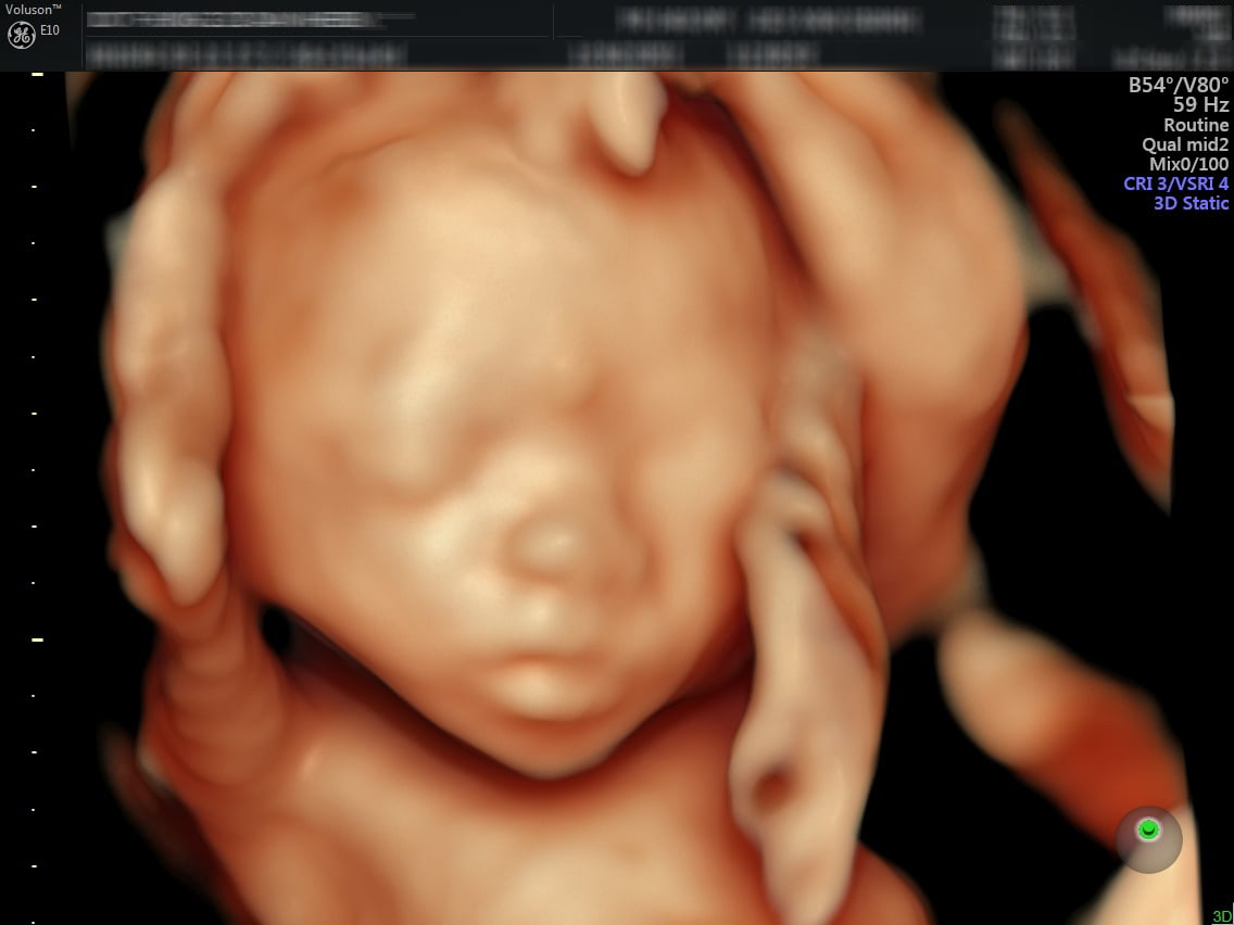 Tổng hợp hình ảnh siêu âm 4D thai 21 tuần mới nhất và chi tiết nhất