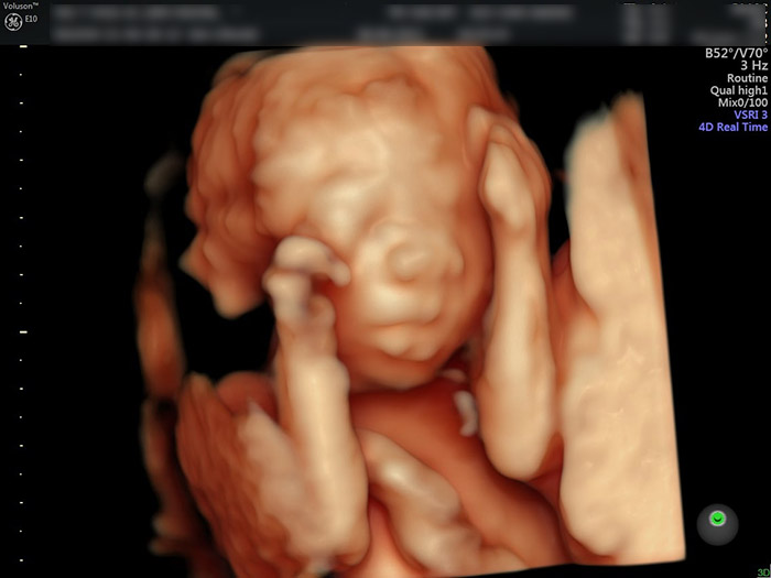 Cẩm nang hình ảnh siêu âm 4d thai 20 tuần chi tiết bào thai và giới tính em bé trong bụng