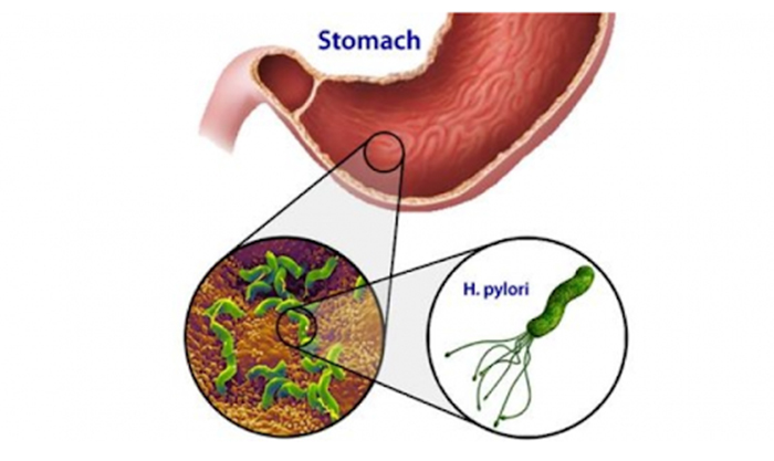 Đau dạ dày mãn tính do nhiễm khuẩn Helicobacter Pylori chủ yếu tập trung ở vùng hang vị và sẽ lan rộng nếu không điều trị sớm
