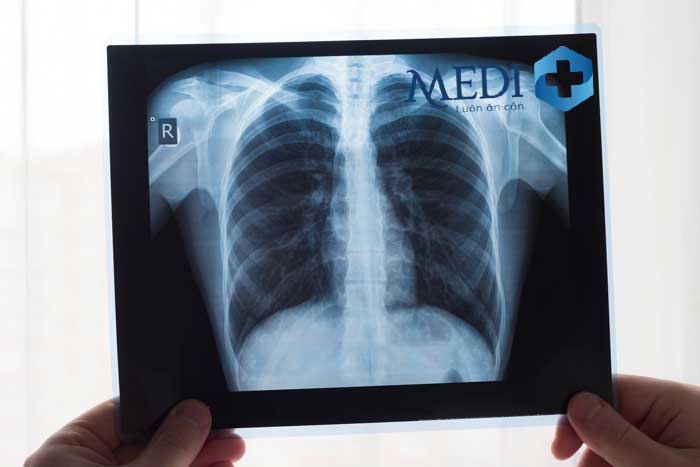 Xem hình ảnh bệnh lý phổi phát hiện sớm để có phương án điều trị kịp thời và tránh các biến chứng nguy hiểm.