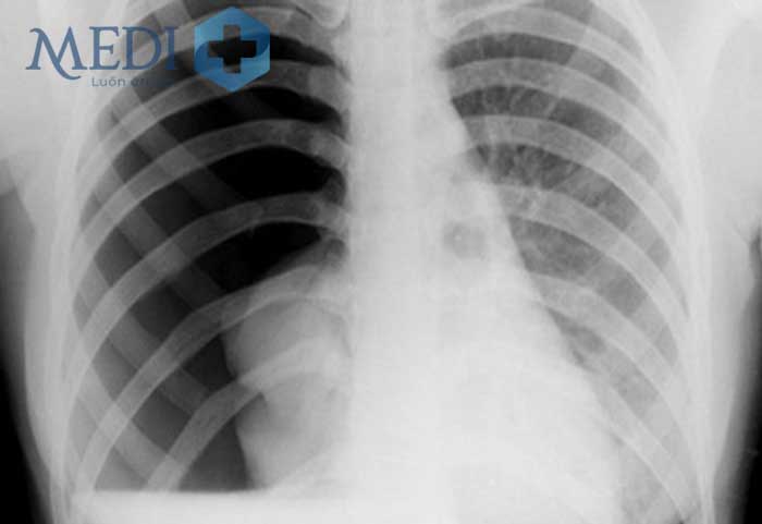 Máy chụp X-quang phổi là một công cụ quan trọng trong việc chẩn đoán bệnh phổi. Hãy xem hình ảnh liên quan để hiểu thêm về cách sử dụng và tầm quan trọng của máy chụp này.