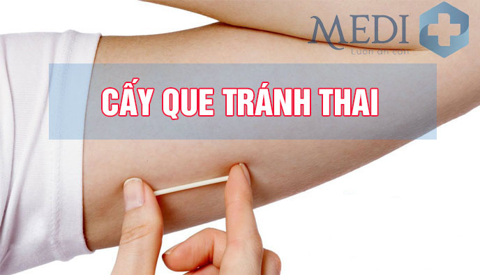 Cấy que tránh thai implanon là gì? Những điều cần biết khi thực hiện