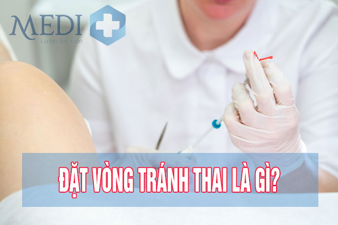 Đặt vòng tránh thai là gì? Các loại và chi phí như thế nào?