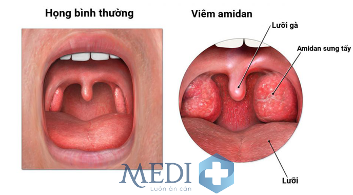 Trẻ nhỏ bị viêm amidan với triệu chứng sốt cao đau họng