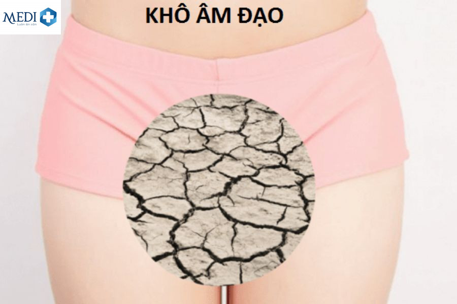 Khô âm đạo là tình trạng âm đạo bị mất đi độ ẩm, giảm tiết dịch 