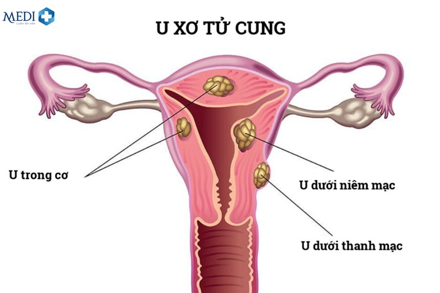 Bị u xơ tử cung có thể quan hệ ra máu đỏ tươi 