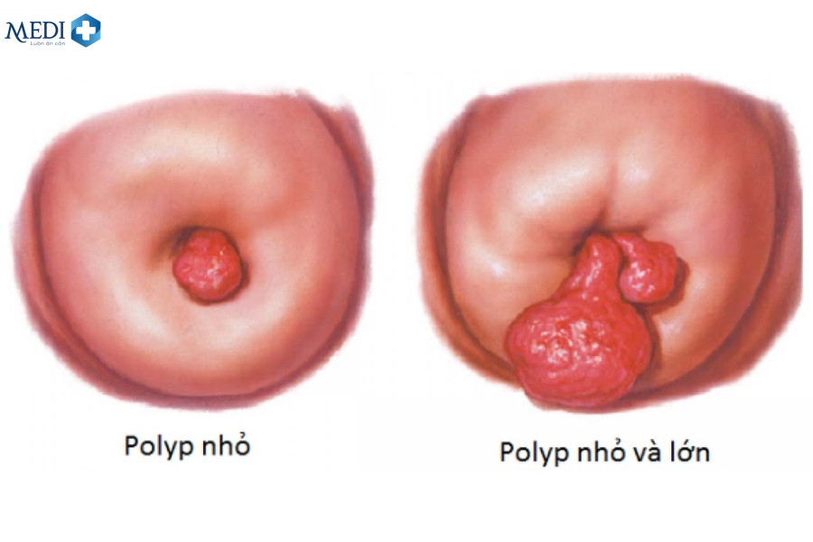 Quan hệ ra máu trước ngày kinh do Polyp cổ tử cung