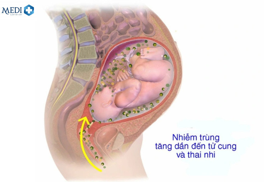 Vỡ ối sớm có thể là dấu hiệu của nhiễm trùng ối