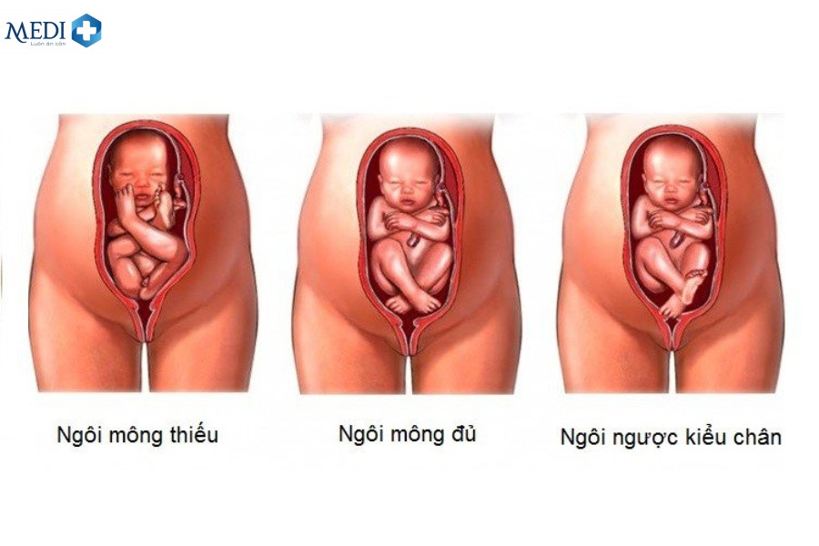 Vỡ ối do ngôi thai ngược hoặc ngôi thai bất thường