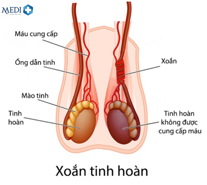 Nguyên nhân dẫn đến đau tinh hoàn bên phải