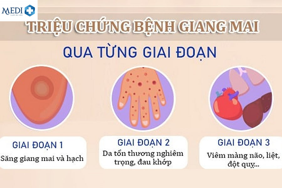 Các giai đoạn phát triển của bệnh giang mai