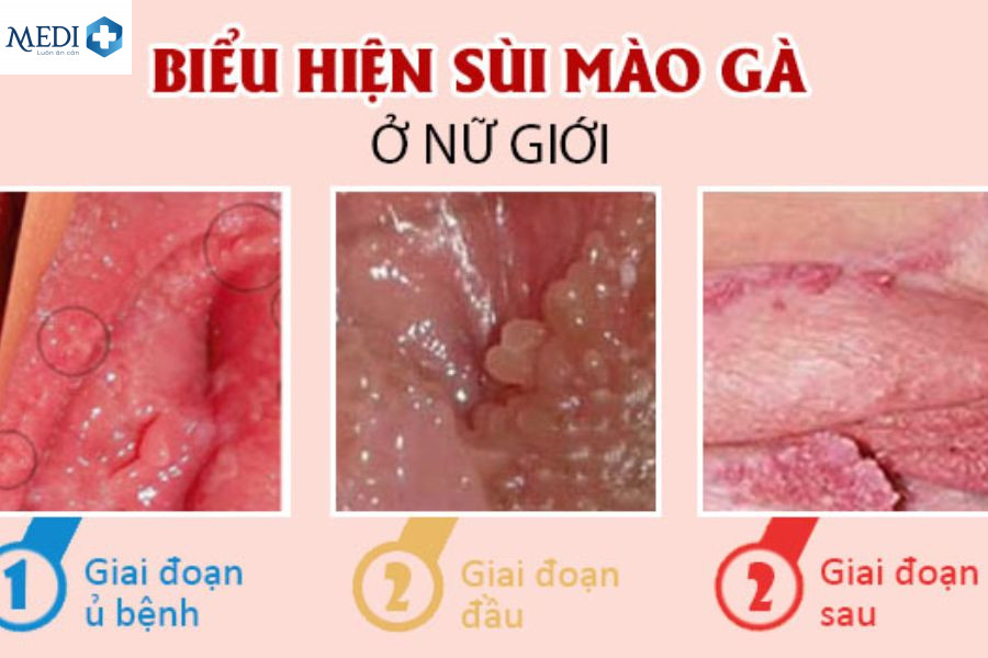 Biểu hiện sùi mào gà ở nữ