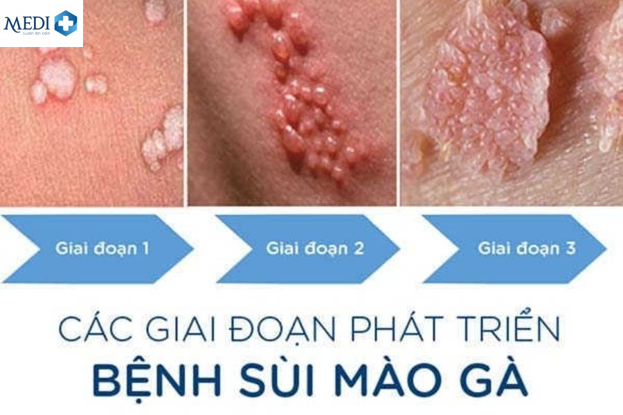 Các giai đoạn phát triển bệnh sùi mào gà