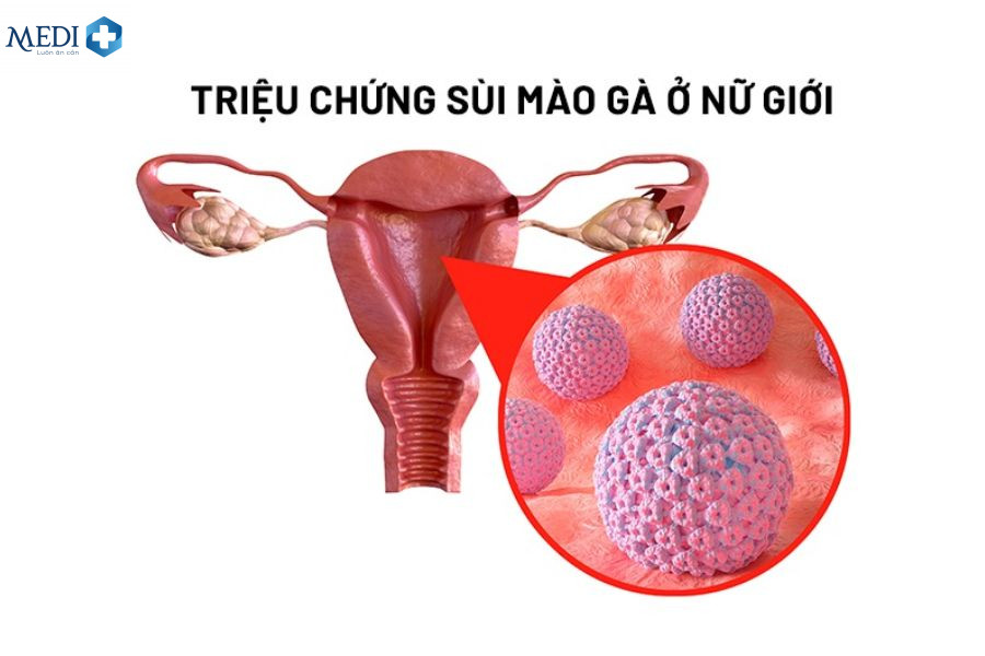 Sùi mào gà giai đoạn cuối sẽ gây lở loét, chảy máu có mùi hôi