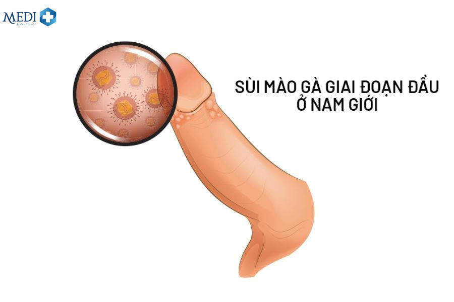 Hình ảnh sùi mào gà giai đoạn đầu ở nam?