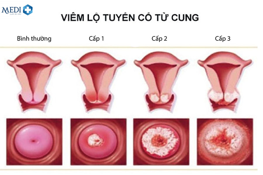 Hình ảnh bệnh viêm lộ tuyến cổ tử cung