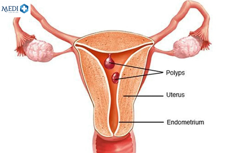 Bị polyp cổ tử cung