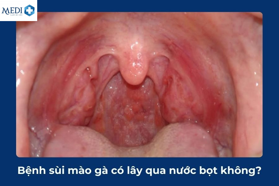 Virus sùi mào gà có trong nước bọt không?