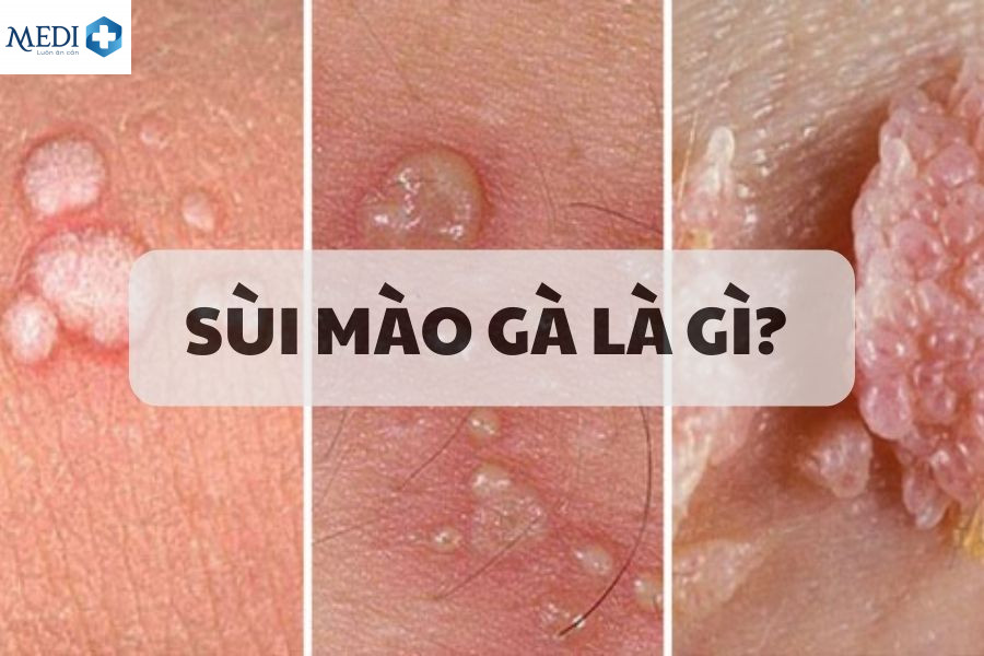 Sùi mào gà là bệnh gì?