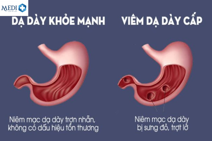 Bệnh viêm dạ dày cấp tính