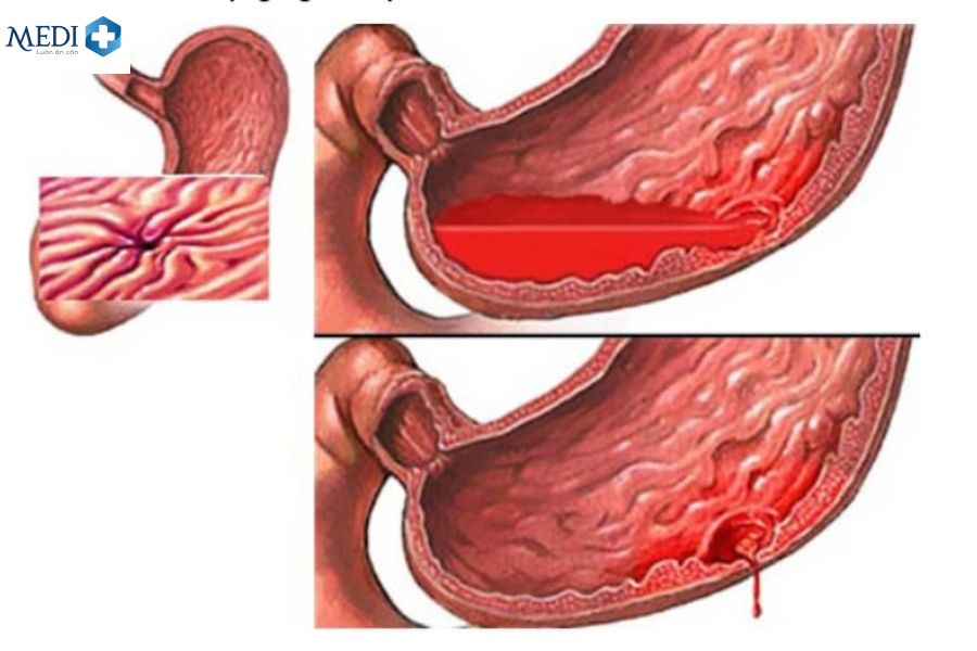 Chảy máu đường tiêu hóa