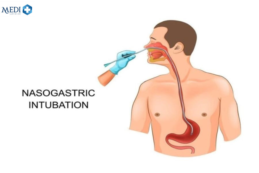 Đặt sonde dạ dày có nguy hiểm không