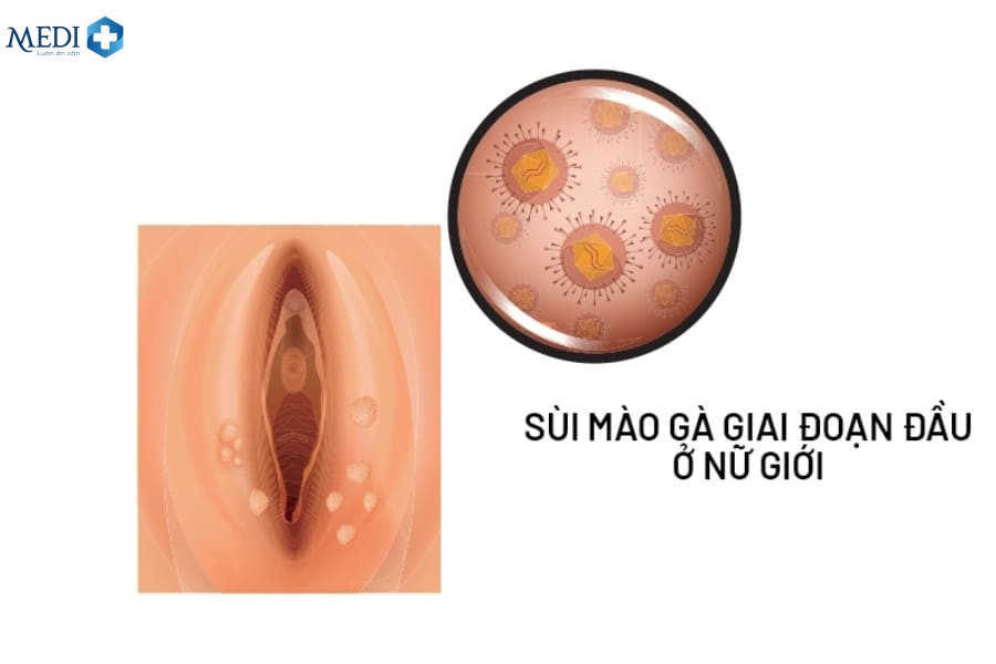 Dấu hiệu sùi mào gà ở nữ