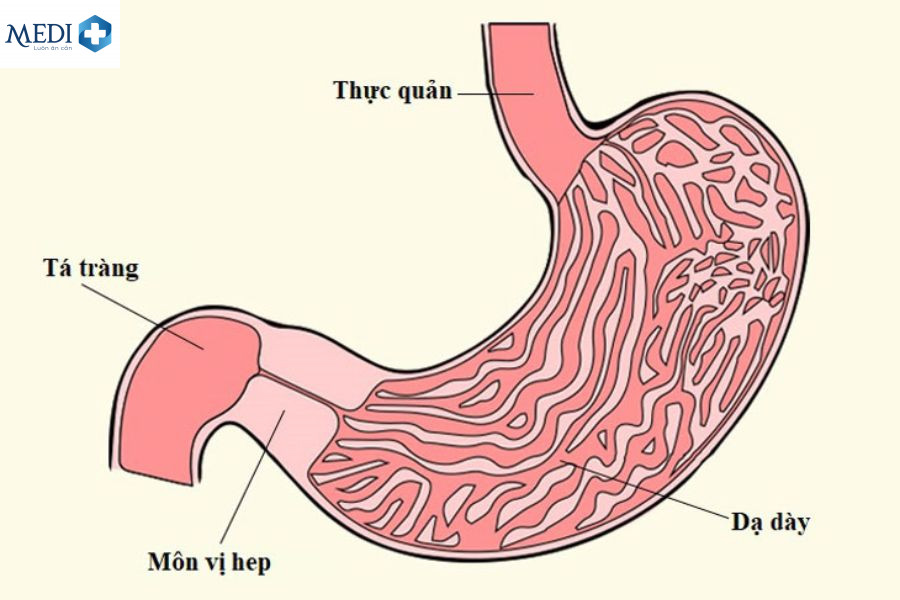 Hẹp môn vị dạ dày