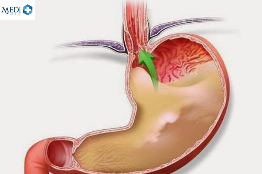 Hở van dạ dày làm cho hơi thở có mùi, cơ thể khó chịu