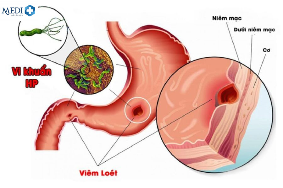 Nhiễm khuẩn HP