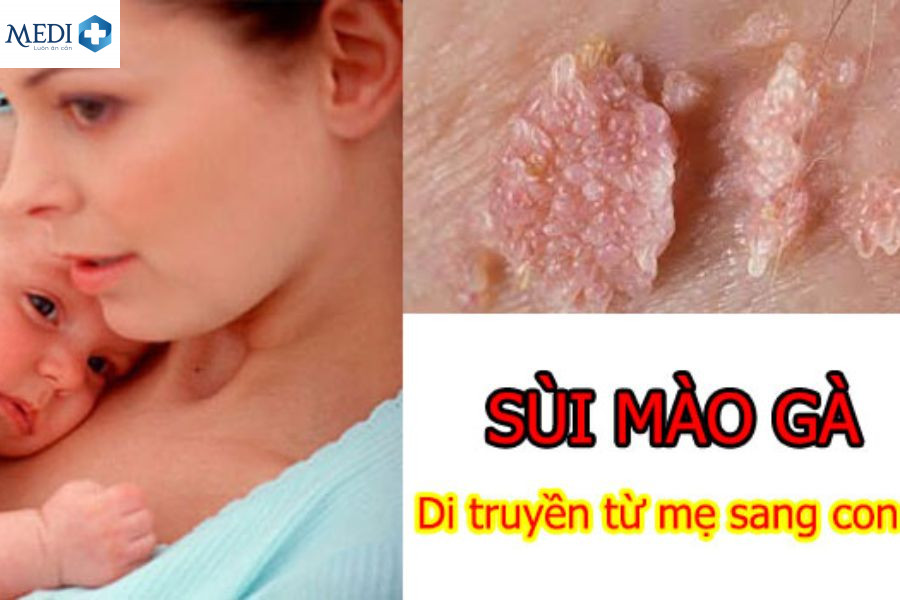 Sùi mào gà do lây truyền từ mẹ sang con