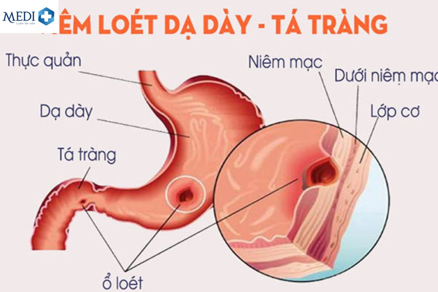 Viêm dạ dày tá tràng là gì?