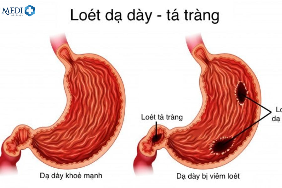 Viêm loét dạ dày