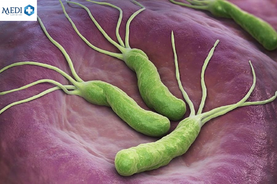 Khuẩn Helicobacter pylori (H.P) là nguyên nhân chính gây ra bệnh