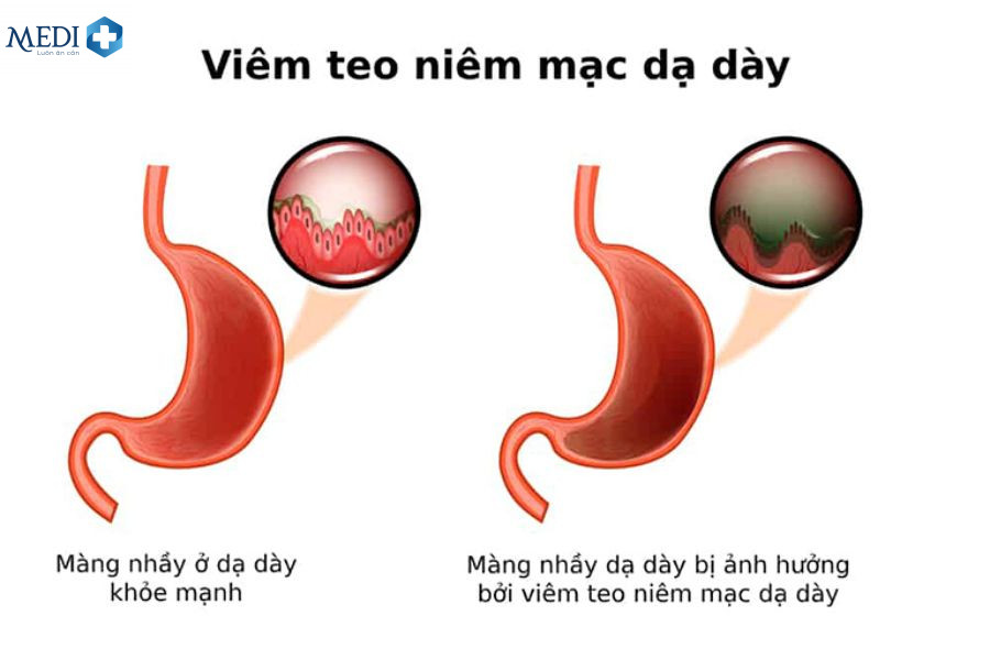 Viêm teo niêm mạc dạ dày C1 do vi khuẩn Helicobacter pylori (H. pylori) gây ra