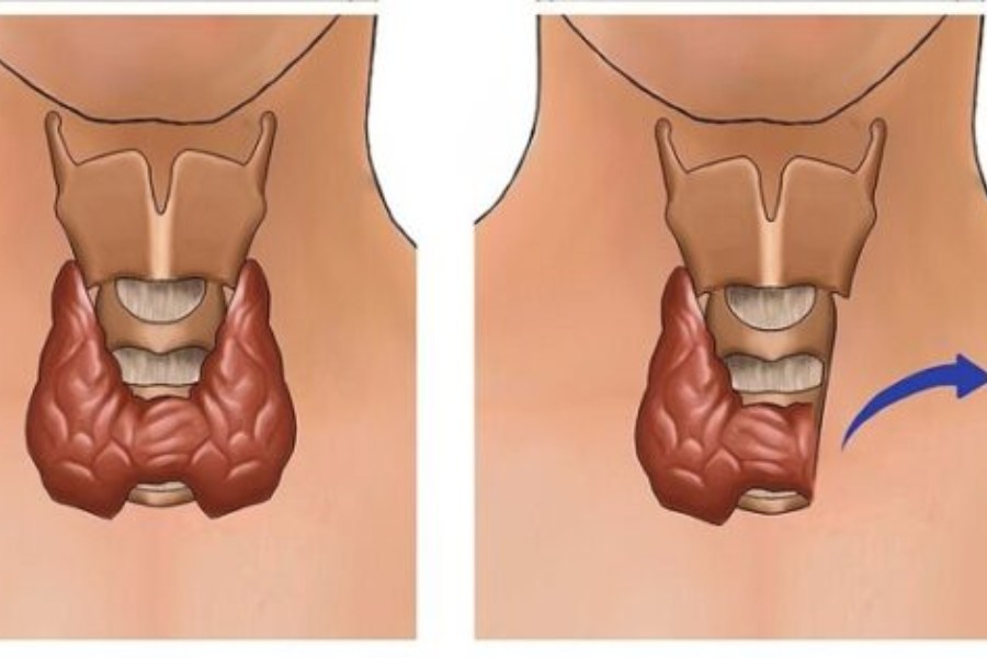 Phẫu thuật cắt bỏ một phần thùy của tuyến giáp