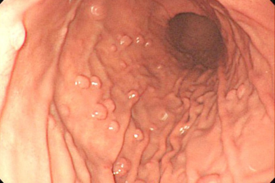 Polyp dạ dày không cuống