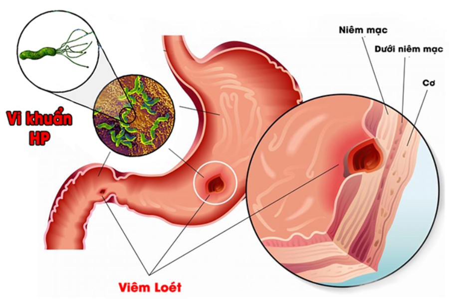  Viêm dạ dày HP dương tính có nguy hiểm không?