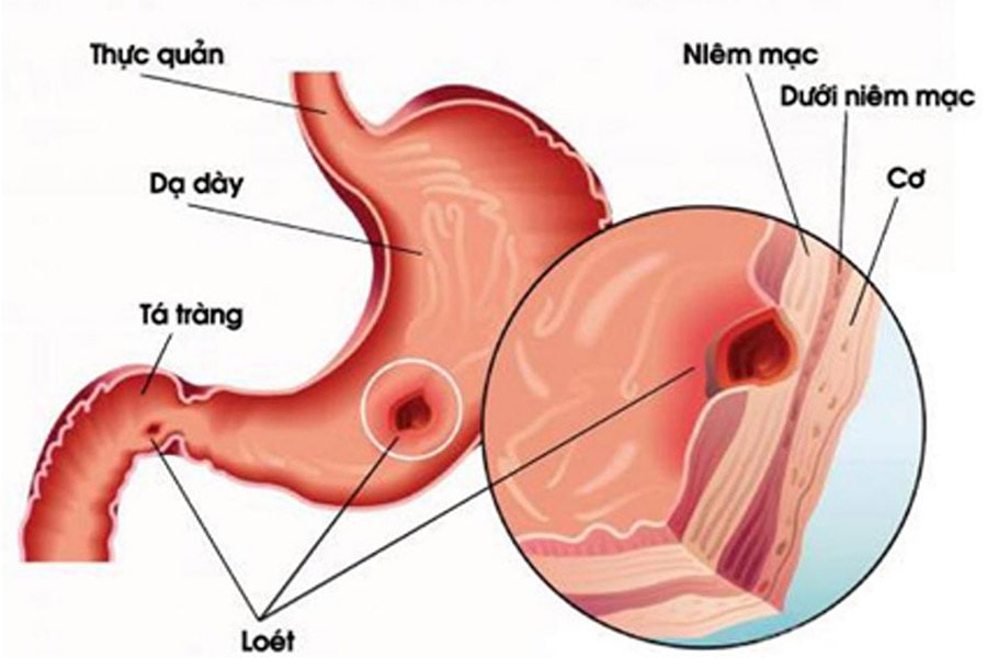 viêm loét dạ dày có tự khỏi được không? vẫn có thể 