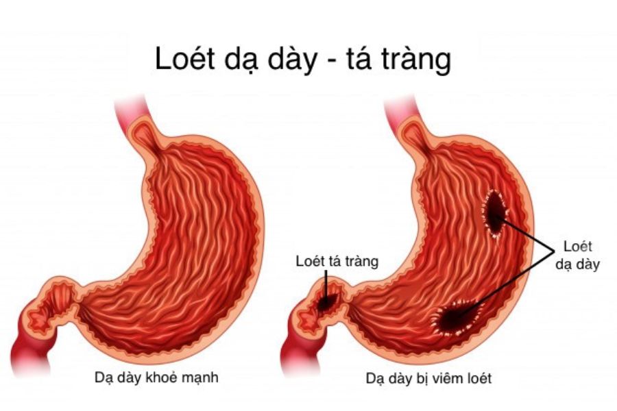 Viêm loét dạ dày là gì? Có nguy hiểm không?