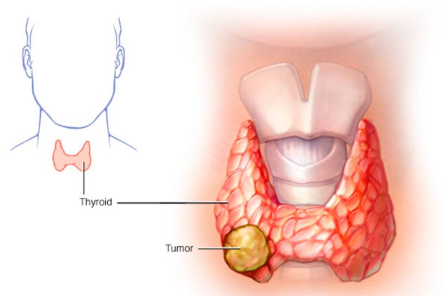 Có rất nhiều nguyên nhân gây ra bệnh K tuyến giáp