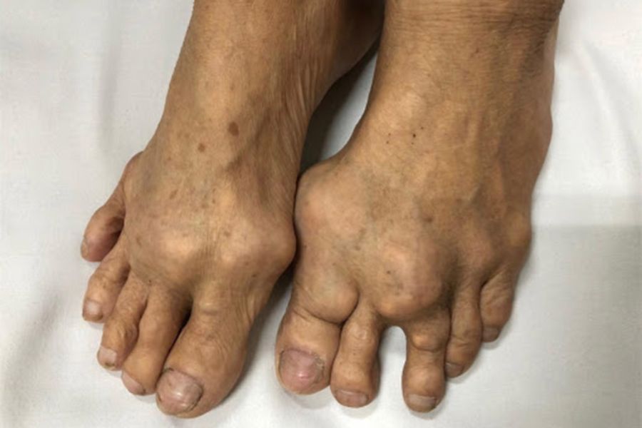 Bệnh gout có chữa khỏi được không? 4 cách chữa và 3 lưu ý