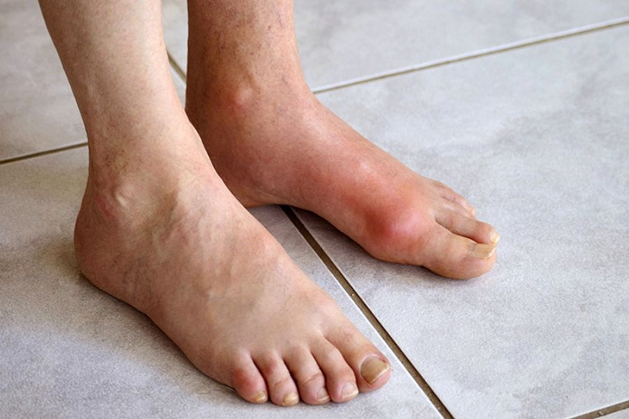  Bệnh gout là gì?