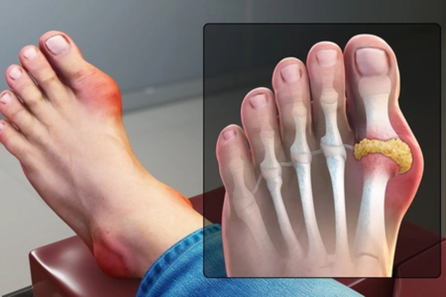 Bệnh gout là tình trạng viêm khớp, do nhiều nguyên nhân khác nhau gây ra