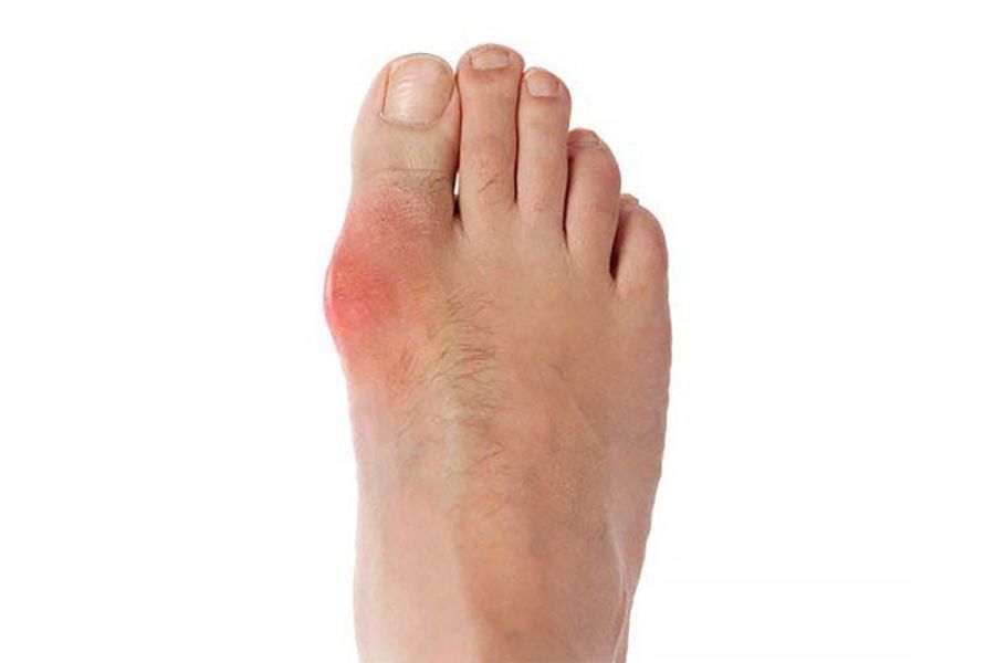 Biểu hiện của bệnh gout là các nốt sưng đỏ, cơn đau thường kéo dài