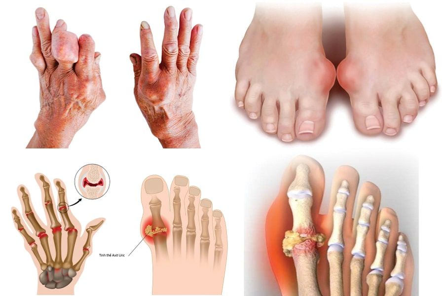 Bệnh gout có hết không? 8 Lưu ý để cải thiện bệnh