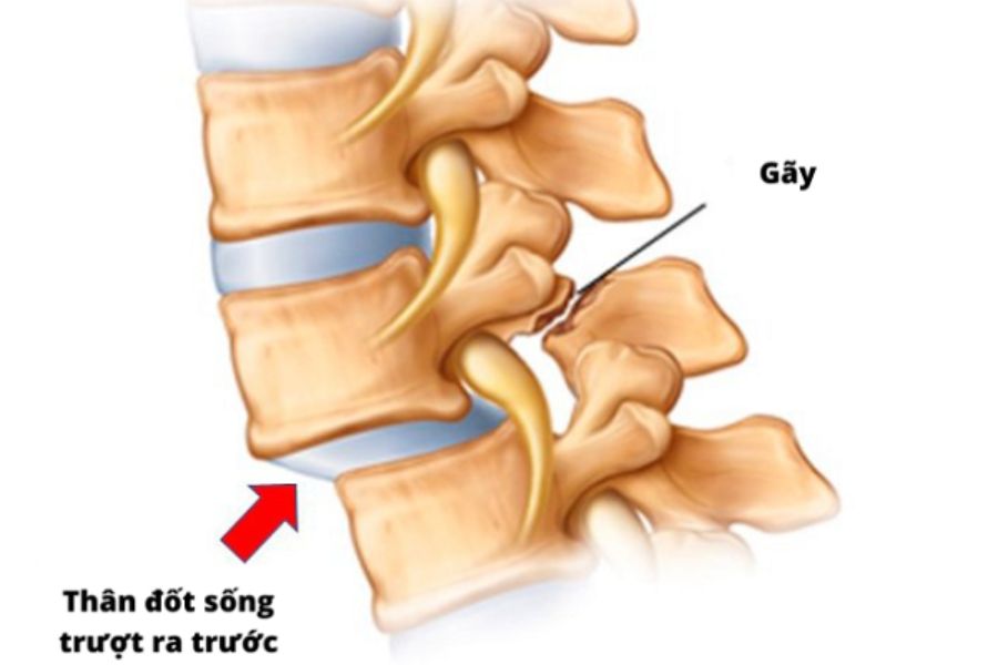 Chùn đốt cột sống là tình trạng xẹp khối xương hoặc thân đốt sống