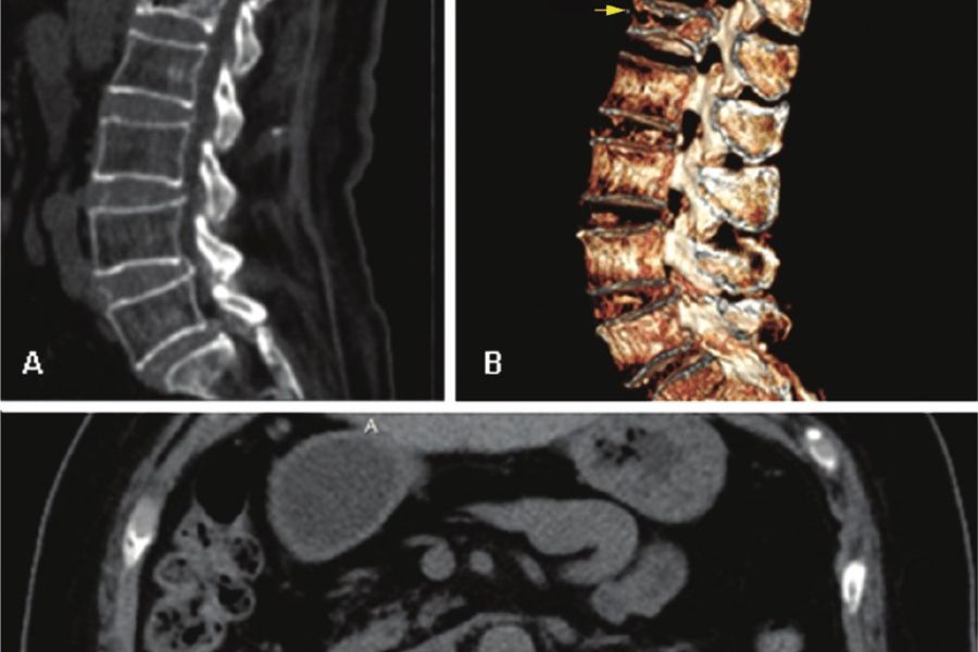 Chẩn đoán chùn cột sống bằng cách CT Scan cột sống