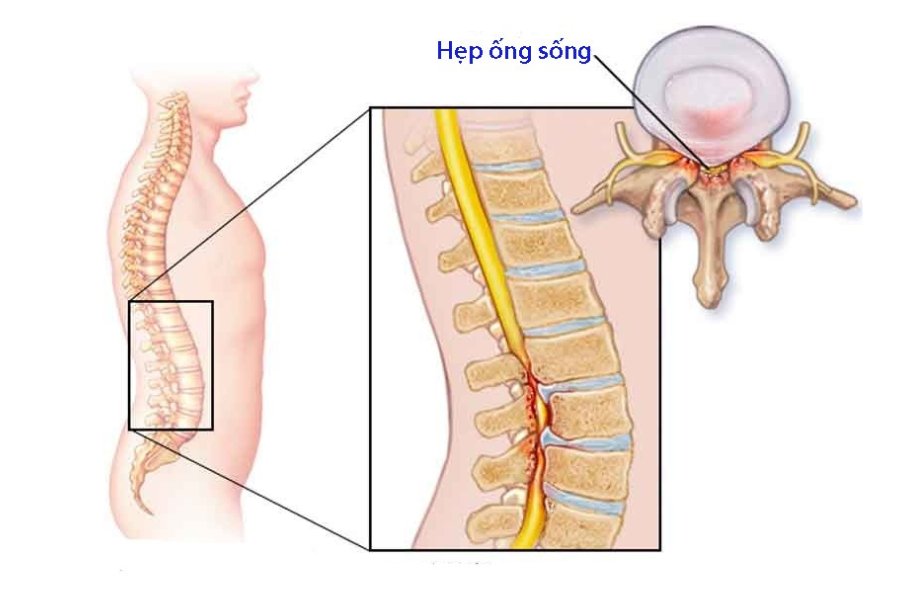 Bệnh hẹp ống sống